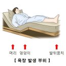 욕창[Skin defect (and/or) soft tissue defect]피부질환 이미지