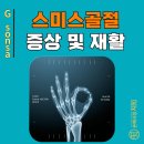 BODY,S SMITH(2층) | 스미스 골절(Smith&#39;s Fracture) : 손바닥 쪽으로 꺾이는 위험한 손목 골절 - [상해정보, AlDa]