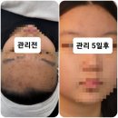 보보스빌딩 | 창원 상남동 여드름관리 아드딸뷰티 사춘기 꼼꼼한 여드름압출 화농성 관리후기