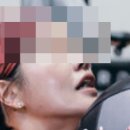 상무병원 | 광주 상무지구 피부과 티타늄 리프팅 60kj 솔직 후기