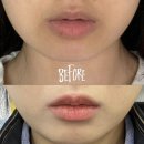 아픔제로한의원 | 부산이중턱 고민, 티타늄 대신 볼뉴머 리프팅 2회차 후기 (효과,가격,주기)