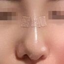 [내돈내산 코 리프팅 후기&amp;문의 환영] 레이디코 필러없는 안전한 시술 &#34;레이디한의원&#34;