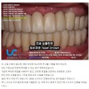 맑은치과기공소 | 앞니 임플란트 임시치아 resin crown (성북구 임플란트)