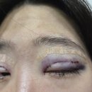 티나성형외과 | 강남 원더풀 성형외과 쌍꺼풀 재수술 두달차 후기/쌍수 붓기 과정/부분절개 후기(내돈내산 쌍수후기)