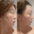 동래피부관리 심부볼처짐해결 인투더래빗홀 리프팅온다 솔직 후기