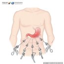 위암(gastric cancer) 이미지