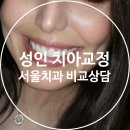 남부치과의원 | 성인치아교정, 서울 치과 5군데 비교상담해본 내돈내산 후기 2탄 (feat. 말많음주의)