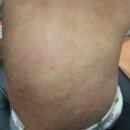 함열사랑약국 | 아토피~ 저리 가~~~!!!