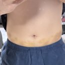 1회 사진기록전 | 30대 사무직 남자의 복부 관리 시작! 홍대다이어트병원 복부제로팻 1회차 후기, 지방분해주사 효과 기록