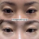 (주)미희 | 눈밑꺼짐 / 다크써클로 인해 강남신논현피부과에서 더미희콜라겐주사 맞은 후기