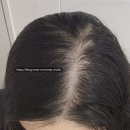 김포 | 출산 후 정수리탈모 김포두피문신 후기