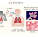 결핵 검사 폐결핵 원인 전염성 방법 이미지