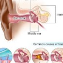 귀 이명 갑자기 귀에서 삐소리 귀울림 원인 이미지