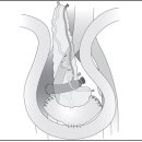 췌장 이식[pancreas transplantation] 이미지