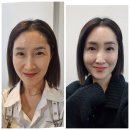 단 1년반‼️인셀덤으로 얼굴 역전!인생역전!인셀덤을알리기위해 오늘도 달립니다.저의 찐 얼굴,인생스토리!