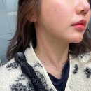 스마트한의원 | 서면 안면비대칭교정 한의원 어느덧 5회차! 꽤 변화된 후기