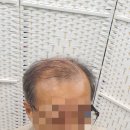 김호증모가발by헤어리서치 이미지
