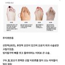 여자들이 많이 걸리는 발가락 질환 이미지