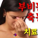 사암침, 사암침법 - 부비동염 축농증 치료방법 - 비과학적 양의학 129 이미지