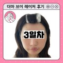 [인천 피부과] 더마브이레이저(더브v레이저) 내돈내산 찐후기 (광고x)