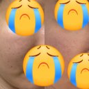 청담더맥한의원 | 오가나셀피부과의원 청담본점 내돈내산 울트라클리어레이저 모공치료 울트라모드레이저