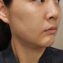 하늘땅어린이집 | 압구정로데오 연예인피부과 추천 텐쎄라 300샷 지방분해주사 내돈내산 후기