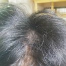 유니베라희망 | 뇌종양 수술후 치료후기 - 환자 돌보기 (2)