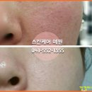 천안여드름예원