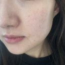 기미 잡티 없애는 미백기능성 브라이트닝 다크 스팟 마이크로패치 사용 후기