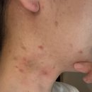 에이피부과의원 | 📍여드름 염증 다스리는 아크네 포텐자 6회차 리얼 후기｜목 여드름까지 진정 성공! (위례)