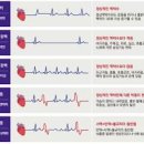 심장 가슴 두근거림 부정맥 증상 빈맥 서맥 원인 성인 정상 맥박수 관리 이미지