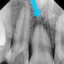 청송치과의원 | 앞니 부딪힘 때문에 영구치 앞니 흔들림 치아 뿌리끝 염증 해결 후기