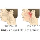 아데노이드의 비대를 동반한 편도의 비대[Hypertrophy of tonsils with hypertrophy of adenoids]귀 이미지