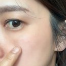 청담아이 | 청담피부과 쥬베룩아이 2회차 후기｜눈밑 볼륨과 팔자주름 관리, 한 달 후 변화는?