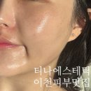 이천피부샵 티나에스테틱 시조피린 단백질관리 후기💆🏻‍♀️