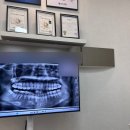 검단퍼스트치과의원 | 잇몸에 하얀 무언가가 생겼어요 ! | 과잉치 ? 뼈돌출 ? 사랑니 ? | 치과후기 | 덕천퍼스트치과의원