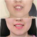 덧니 반대교합 발치 교정 인비절라인 치료기간 2년4개월 재제작 1회 치료 후기