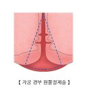 자궁경부 원추절제술 이미지