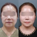거상광고 | 안면거상 후기, 전후사진만 믿고 결정하면 안 되는 이유