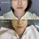 미소의원 - 마포구 마포대로 52 | 마산 피부과 친절한미소의원 쿨소닉 리프팅 후기, 통증과 전후 비교