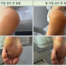 문제성 손,발 오감네일