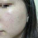 대전 탄방동 피부과_ 이동규의원 (오픈런 후기)