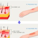 화상입었을때 응급처치 123도 화상 구분 이미지