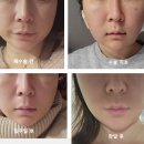 김형진 | [내돈내산] 얼굴지흡, 심부볼 제거 수술 찐후기, 부작용 | 김형진베이직, 샤프성형외과