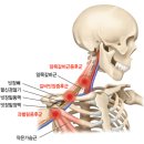 흉곽출구 증후군이란? 이미지