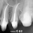 엔도코어 이미지