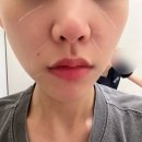 강남구청역피부과 솔린의원 세르프멍 붓기 전후 후기｜무너진 얼굴라인 자연스럽게 정리