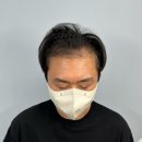 [남성 헤어라인 교정 후기] M자 고민 끝! 두피문신 4회차 리얼 후기