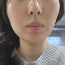 필 | 평택고덕피부관리 : 더맑은스킨 평택에듀타운점 워터필 후기