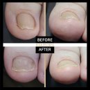 홀드핀칭 이미지